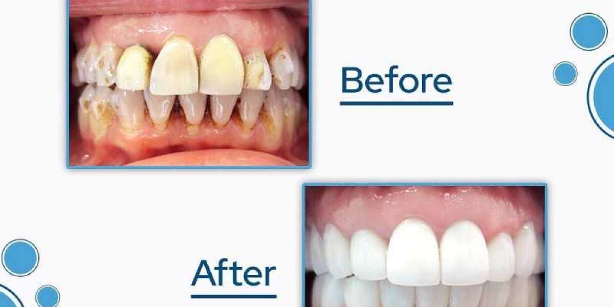 Unlocking Radiance: The Advantages of Professional Teeth Whitening (Dental Crown)